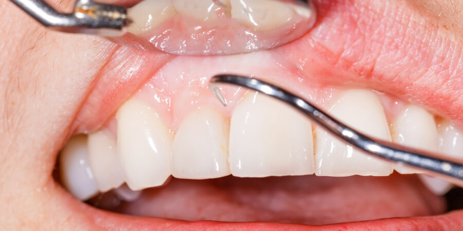 歯を失ってしまう前にしっかりとした歯周病治療を。歯周病治療