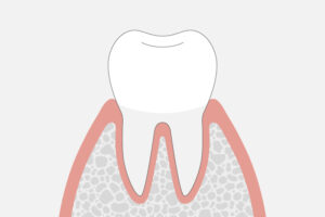 歯肉炎（歯周ポケットの深さ1〜2mm）