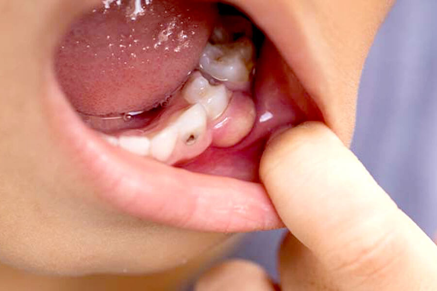 歯の根っこが割れている歯